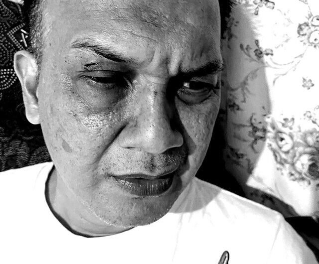 Kondisi Lurah Manggarai Selatan Muhamad Sidik babak belur usai diamuk massa demo. Foto: Dok. Istimewa